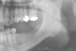 Möglichkeiten der DVT in der Implantologie