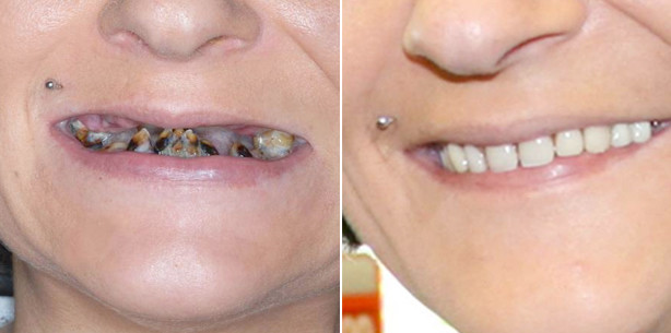 15 Jahre Zahnarzt-Abstinenz: Dentaler Horror mit Happy End