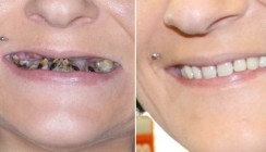 15 Jahre Zahnarzt-Abstinenz: Dentaler Horror mit Happy End