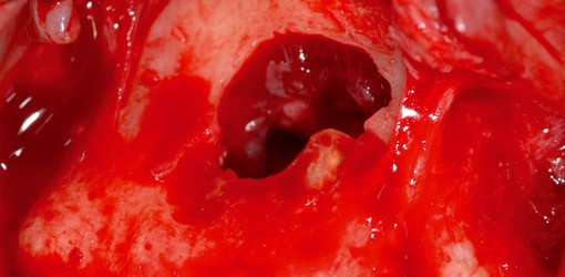 Therapiemöglichkeiten der nasopalatinen Zyste