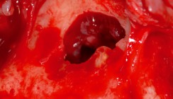 Therapiemöglichkeiten der nasopalatinen Zyste