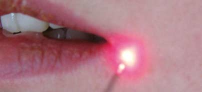 Physikalische Herpes-simplex-Virus-1-Therapie mit dem Diodenlaser