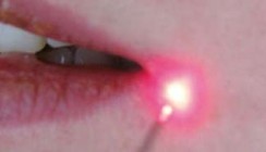 Physikalische Herpes-simplex-Virus-1-Therapie mit dem Diodenlaser