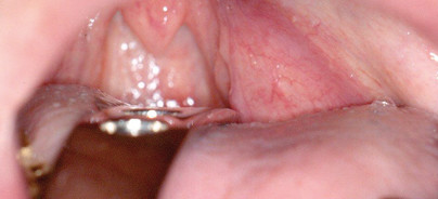 Erkrankungen der Speicheldrüsen – die Tumoren