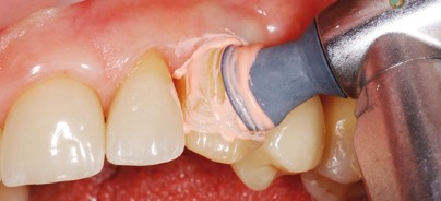 Implantatkronen: Funktion und Ästhetik lange erhalten