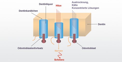 Überempfindliche Zahnhälse