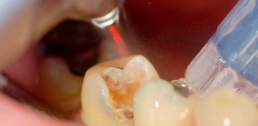 Die bessere Wahl: Konventionell oder mit Laser?