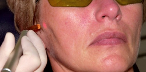 Erste Erfahrungen mit mobilem Diodenlaser
