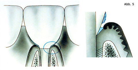 Parodontitis gleich Periimplantitis?