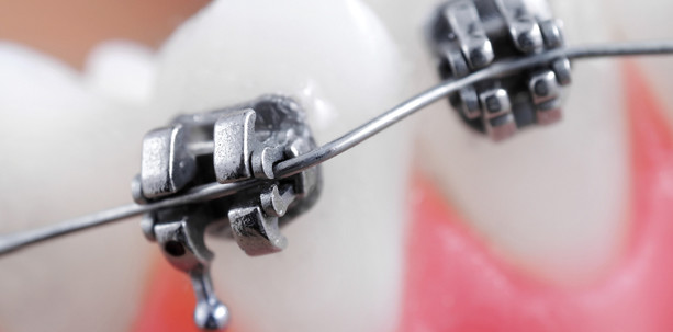 Klammern für die Teenies