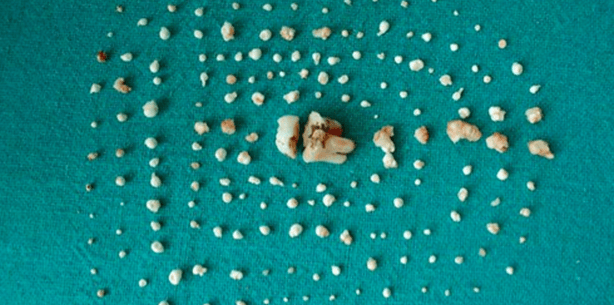 Sensations-OP: Zahnärzte entfernen 202 Zähne aus Kindermund