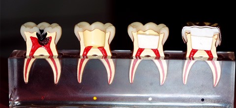 Vitalamputationen an Milchmolaren
