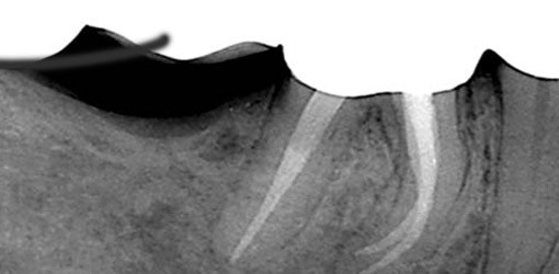 Mikroskopunterstützte Revisionsbehandlung