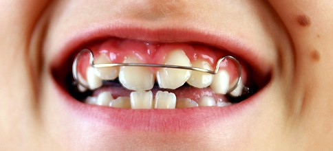 Warnung vor Vernachlässigung kieferorthopädischer Vorsorge