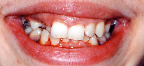 Einstellung palatinal verlagerter Oberkiefereckzähne