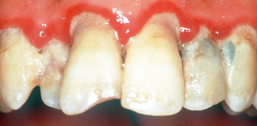 Parodontale Risikobestimmung und Festlegung des Recalls