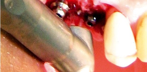 Problemfall Periimplantitis - der Er:YAG-Laser hilft