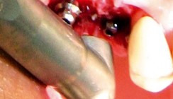 Problemfall Periimplantitis - der Er:YAG-Laser hilft
