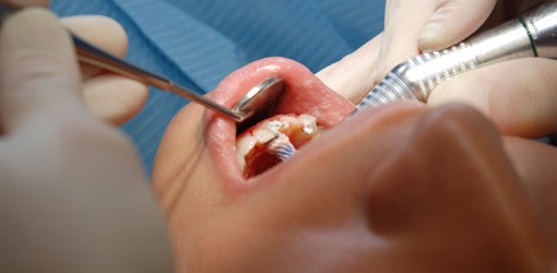 Richtige Zahnpflege hilft bei Diabetes