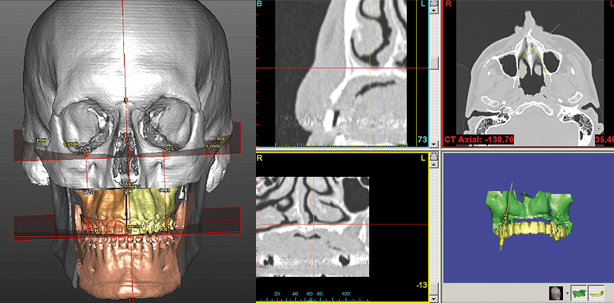 3-D-Planung und klinische Umsetzung von dentalen Implantaten