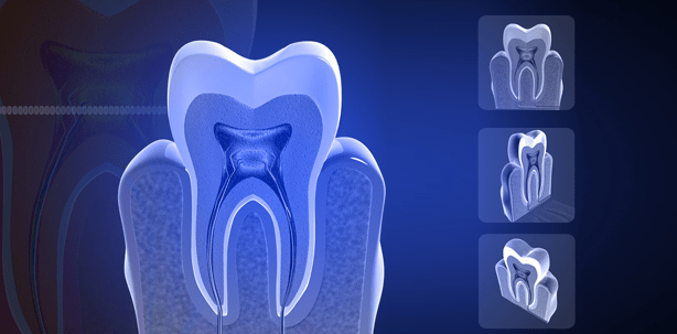 Mit 3-D-Bildern Karies auf der Spur