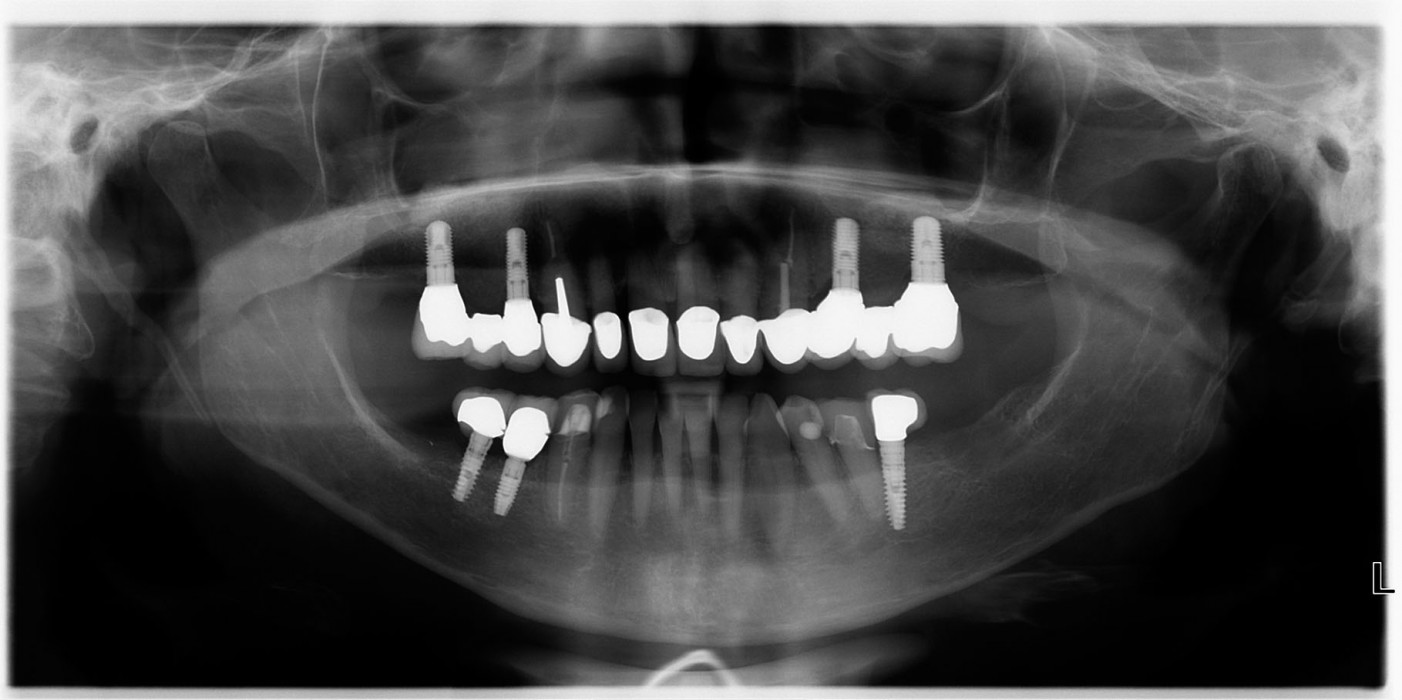 Beidseitige externe Sinusboden­elevation mit Implantation