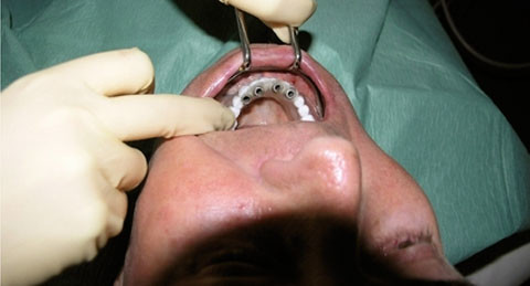 Edelmetallfreie Implantatversorgungen