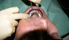 Edelmetallfreie Implantatversorgungen