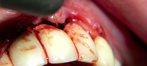 Der Diodenlaser in der Zahnheilkunde