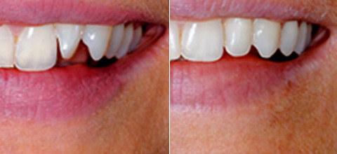 No Prep Veneers – Das neue Standardverfahren?