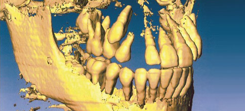 Zähne wie durch Glas sehen