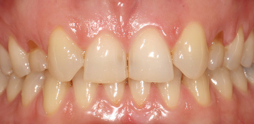 Sofortimplantation bei Verlust der Milchzähne