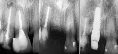 Prospektivität eines mehrfach resizierten Frontzahnes