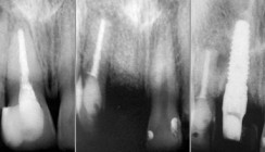 Prospektivität eines mehrfach resizierten Frontzahnes