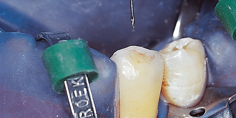 Die Wurzelkanalaufbereitung - Grundlage des Erfolgs