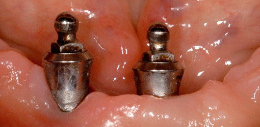 Periimplantitisbehandlung mit Laser