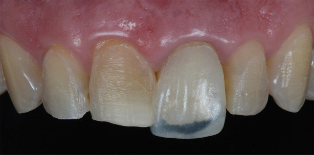 Verbesserte Ästhetik mit CAD/CAM-Verfahren
