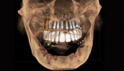 Vorteile der prothetisch orientierten 3-D-Implantatplanung