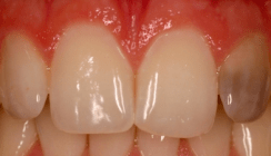 In-Office-Bleaching