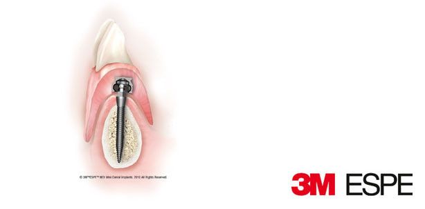 Gutes Verschleißverhalten und kontinuierliche Beißkraftsteigerung