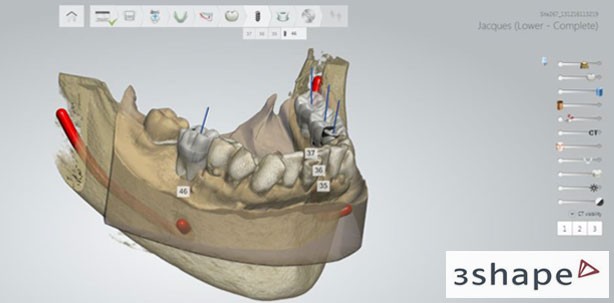 3Shape veröffentlicht Implant Studio™-Software