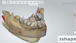 3Shape veröffentlicht Implant Studio™-Software