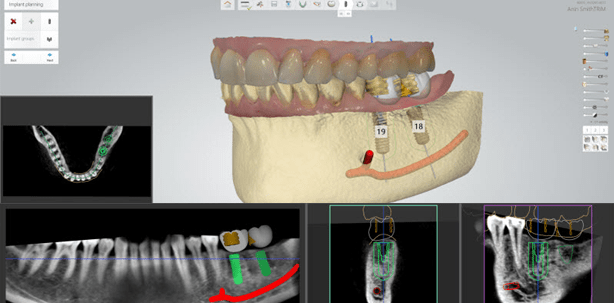 3Shape Implant Studio™ jetzt mit Straumann®-Implantaten verfügbar