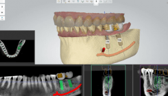 3Shape Implant Studio™ jetzt mit Straumann®-Implantaten verfügbar