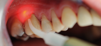 Parodontale Furkationsbehandlung mit Laserlicht und Chlorhexidin-Xanthan-Gel
