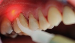 Parodontale Furkationsbehandlung mit Laserlicht und Chlorhexidin-Xanthan-Gel