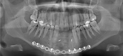 Rehabilitation in der Unterkieferfront