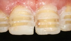 Minimalinvasive Zahnmedizin – das Mock-up zur Schonung der gesunden Zahnhartsubstanz
