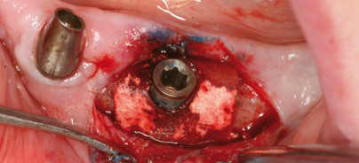 Wer stellt die Indikation für die Periimplantitistherapie?