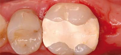 Multi-Purpose-Dentinersatzmaterial auf Basis der aktiven Biosilikat-Technologie
